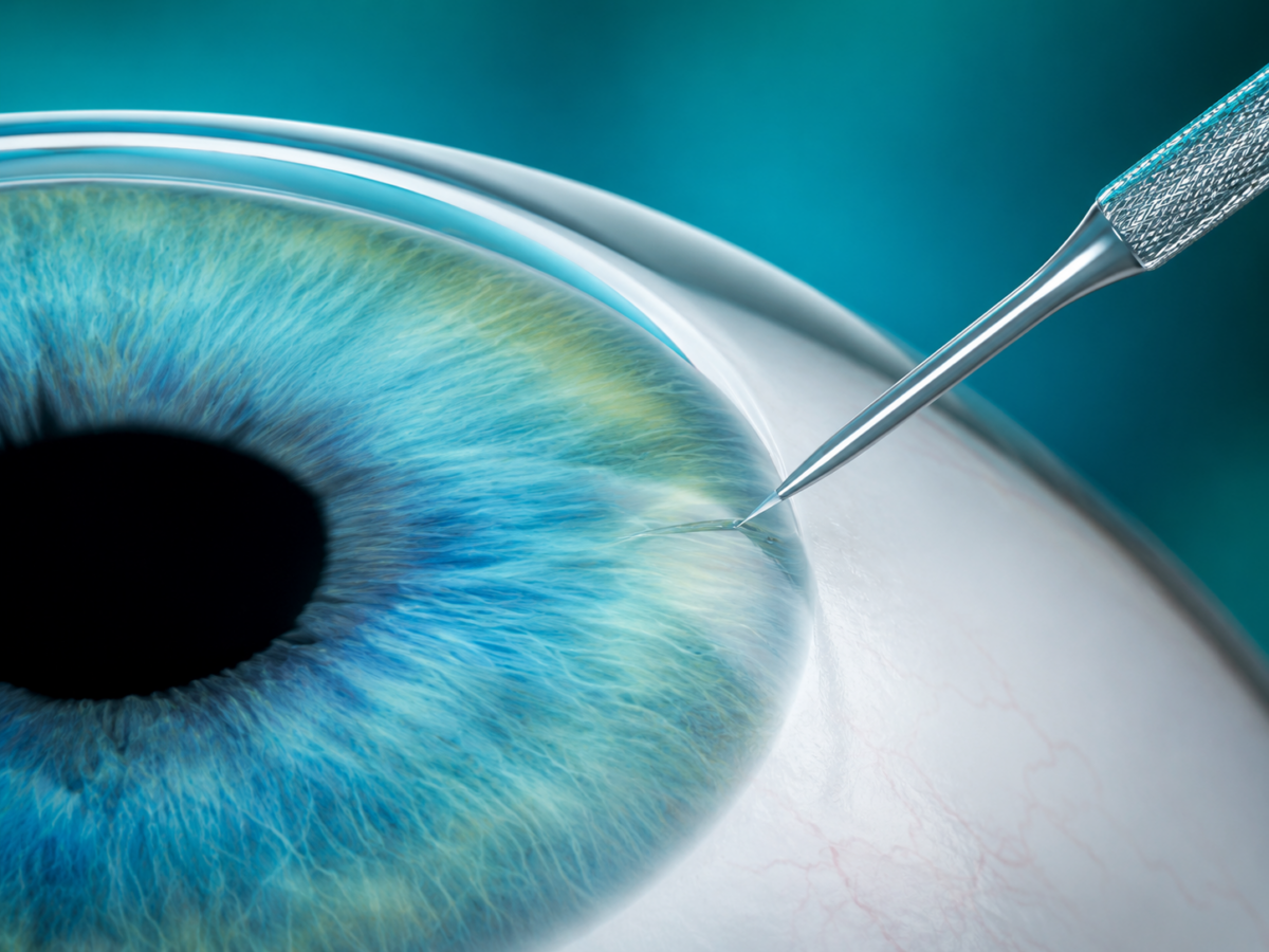illustration of a tiny incision being made at the edge of the cornea for an RLE procedure