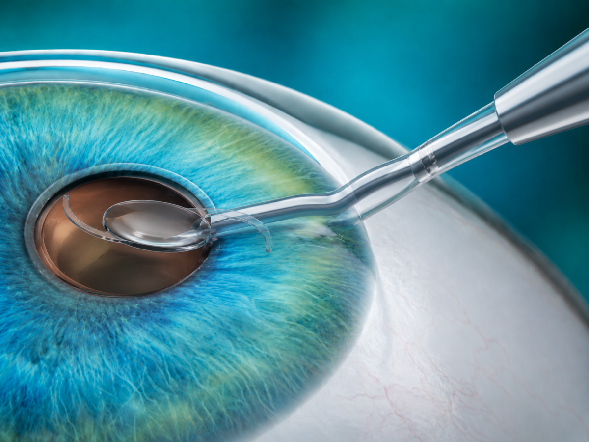 Illustration of A custom intraocular lens is inserted to replace the natural lens and correct vision.